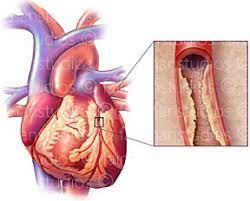 پاورپوینت سندروم حاد کرونری